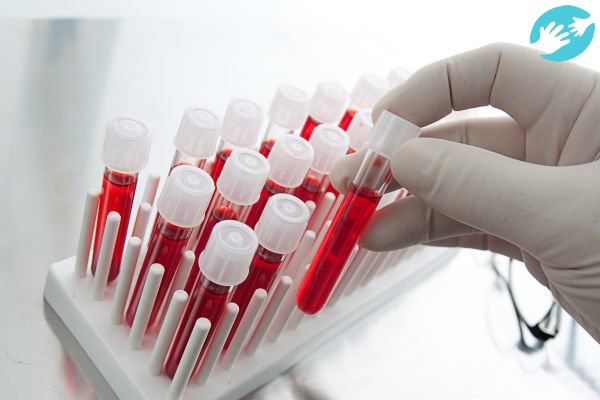 С помощью анализа крови можно определить уровень гормона ХГЧ в крови