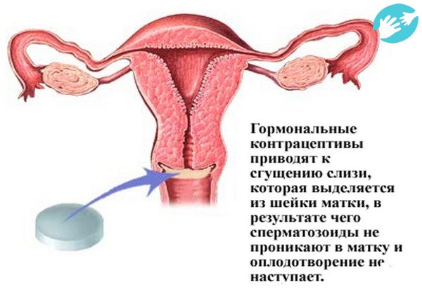 Во время приема противозачаточных таблеток сперматозоиды не проникают в матку и беременность не наступает.