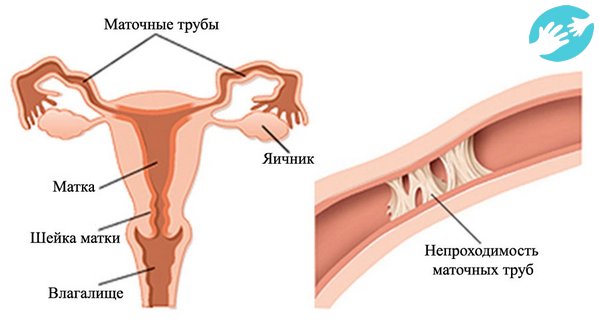 Предварительные причины непроходимости маточных труб можно выяснить после осмотра или по результатам встречи с гинекологом
