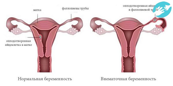Высокая базальная температура во второй фазе цикла может говорить о наличии внематочной беременности .